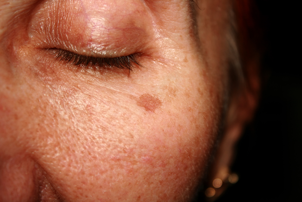 Age Spots Treatment Ocala Lady Lake Fl